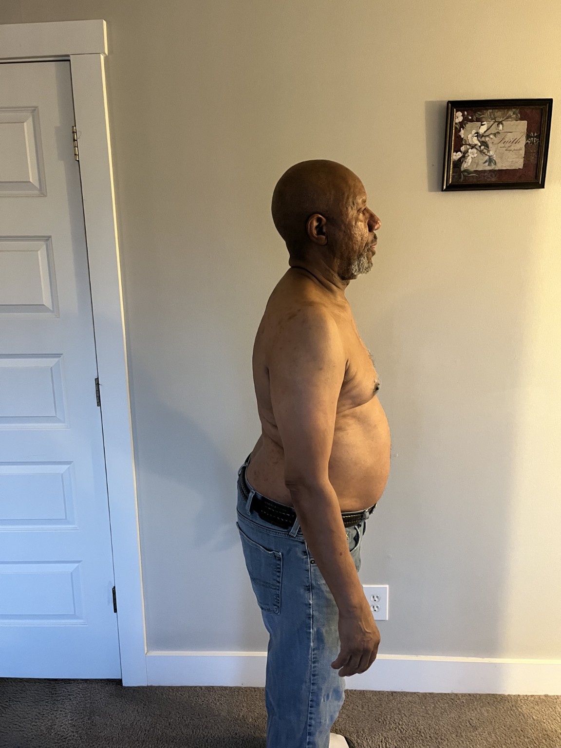 Age 75 client before photo, side view